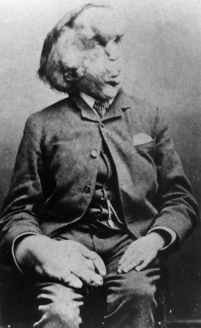 The Elephant Man, Joseph Merrick | © The Arty Farty Cool Dude/WikiCommons